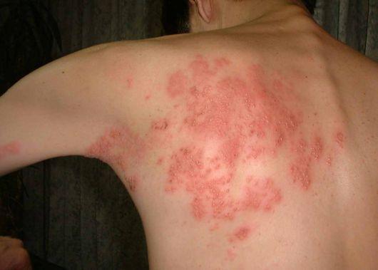 Shingles which is also known as Herpes Zoster is a painful skin rash caused by the Varicella virus. The Varicella virus belongs to the herpesviridae family.