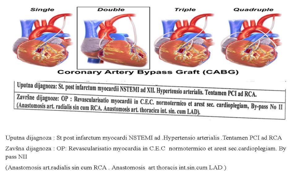 PRIKAZ SLUČAJA/CASE REPORT 63 Slika 7. Aorto koronarni By-pass Figure 7. Aorto coronary By-pass Slika 8. EKG nakon revaskularizacije miokarda Figure 8.