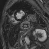 Kratka os, perfuzijsko slikanje štiri dni po koronarografiji. Izpad perfuzije anterolateralno subendokardno. 52 Slika 2B.