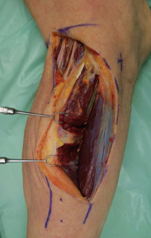 Anatomic dissection of the superficial lateral sural and peroneal pedicle, both providing blood supply to the skin of the posterolateral calf.
