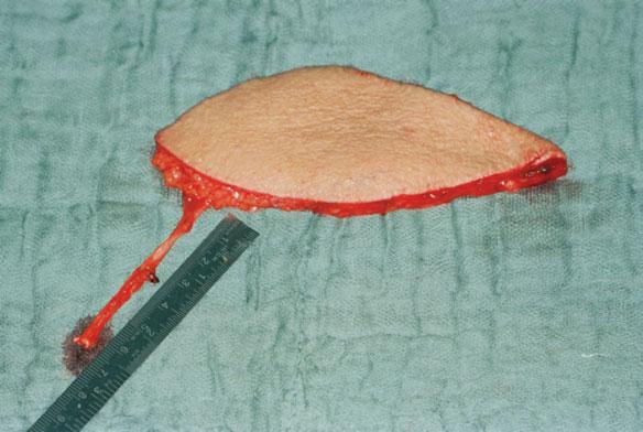 WOLFF ET AL. FIGURE 7. Thin flap after harvest (case 6). [Color figure can be viewed in the online issue, which is available at wileyonlinelibrary. com.] despite early revision.