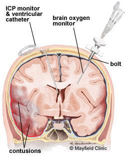 Measure of blood flow 1) Brain oxygen monitor