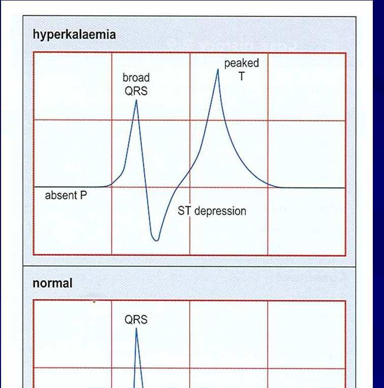 Characteristic ECG changes in hyper- and hypokalaemia.