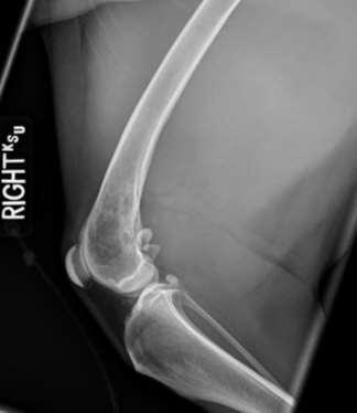 Right Lateral: Radiographic Interpretation: There is permeative osteolysis of the right distal femur at the level of the metaphysis and the medial condyle.