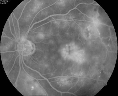 After the injection, indirect ophthalmoscopy fundus examination was used to evaluate the perfusion of the central retinal artery and the intravitreal location of the triamcinolone.