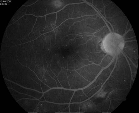 iop was assessed after 4 hours and Fundus was examined to rule out any complication.