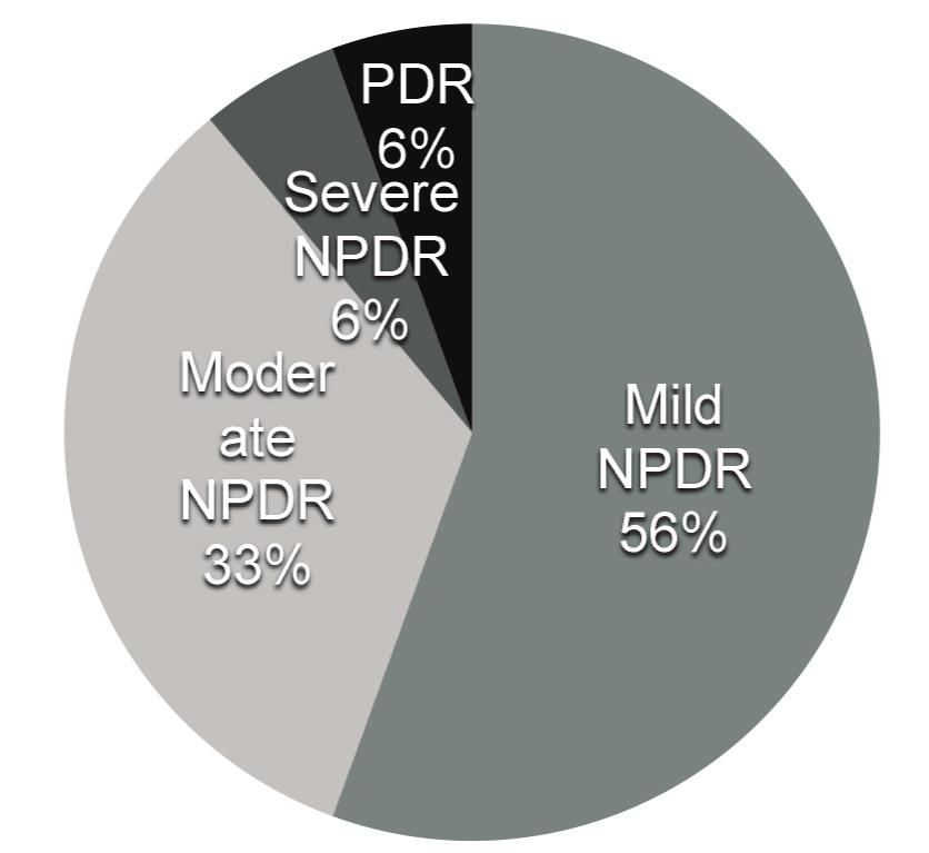 Results In this study, the overall prevalence of any DR was 26% (n=18): 55% mild NDPR, 33% moderate NDPR, 6% severe NPDR and 6% PDR (Figure 4). DME was present in 22% of patients with any form of DR.