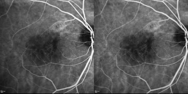 efigure 4d: Example case of PCV patient treated with ranibizumab 0.5 mg + vpdt combination therapy Month 3 ICGA 66 year-old male presented with PCV in the right eye.