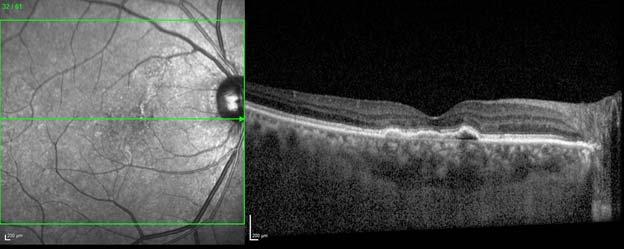 At Month 3, the BCVA letter score (approximate Snellen equivalent) 63 (20/50) and the CSFT was 222 µm BCVA, Best corrected visual acuity; CSFT, Central subfield thickness; ETDRS, Early Treatment
