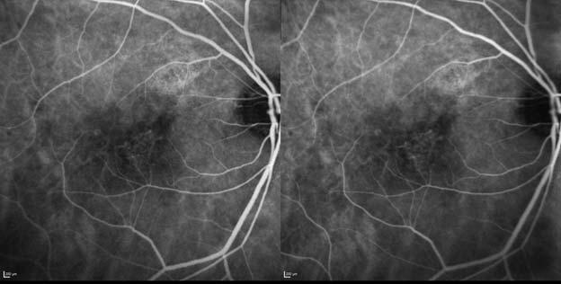 BCVA, Best corrected visual acuity; CSFT, Central subfield thickness; ETDRS, Early Treatment Diabetic Retinopathy Study efigure 4f: Example case of PCV patient treated with ranibizumab 0.