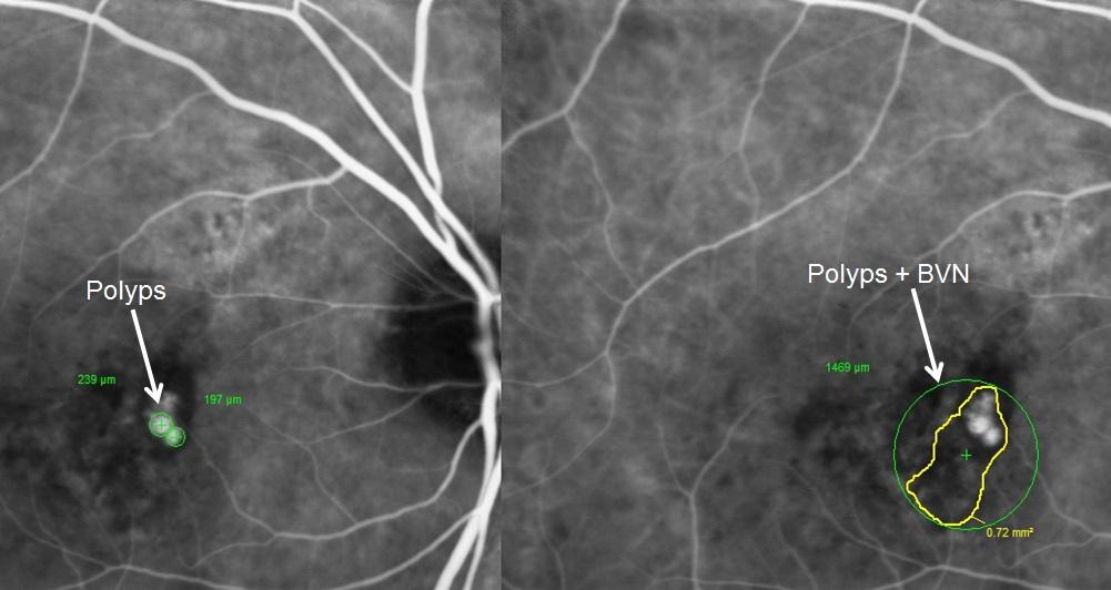 66 year-old male presented with PCV in the right eye. Baseline screening BCVA letter score (approximate Snellen equivalent) 59 (20/63) and CSFT was 463 µm.