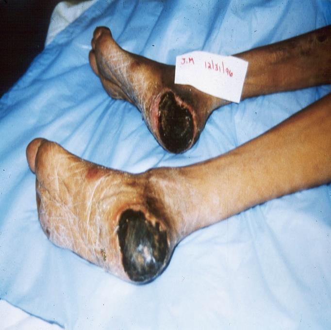 A note on dry stable eschar Wound is covered with thick, leathery necrotic tissue If this is *dry, non-boggy, and attached on all edges*, it is considered STABLE.