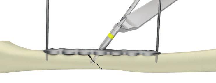 The lag screw may either be placed 90 degrees to the fracture line or placed at the midpoint between perpendicular to the fracture line and perpendicular to the long axis of the bone.