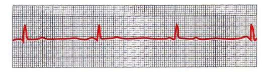 Abnormal Sinus Rhythms (cont d) Bradycardia means a slow heart rate usually less than 60 beats /min Present in athletes who