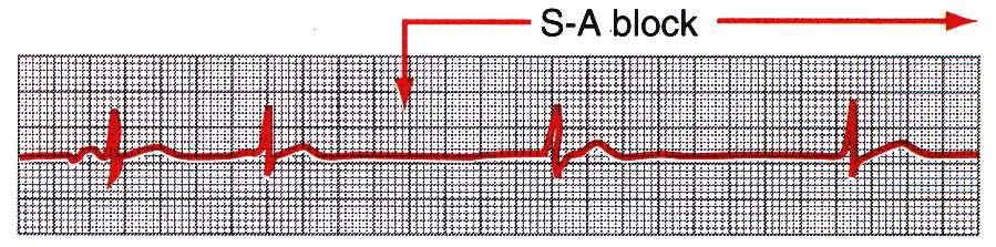 Sinoatrial Block In rare instances impulses from S-A node are blocked. This causes cessation of P waves.
