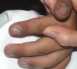 plate with the axis of the finger Abnormal sponginess of the