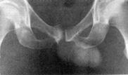 X ray moth -eaten appearance pubic symphysis Bone Scan