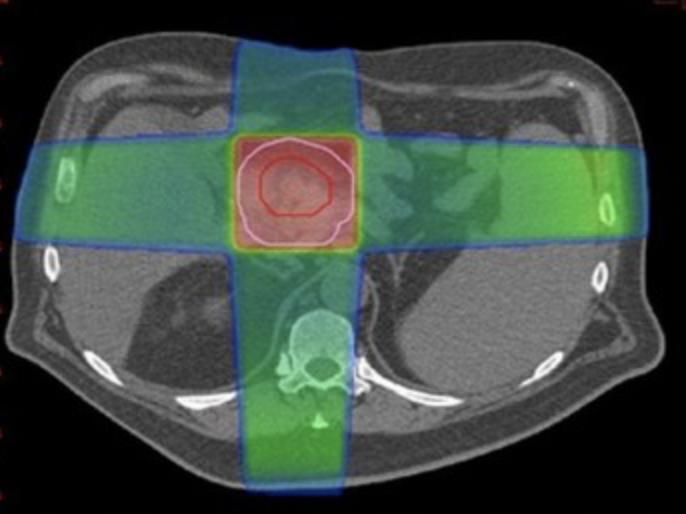 Intensity Modulated Radiation Therapy (IMRT) Radiation is delivered with multiple beams or arcs