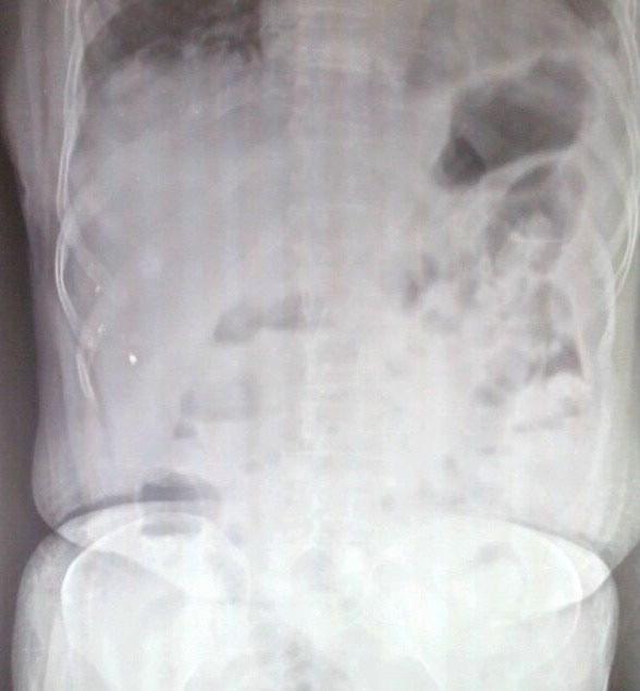 [ Dilated small bowel loops with air and fluid] [Multiple jej.