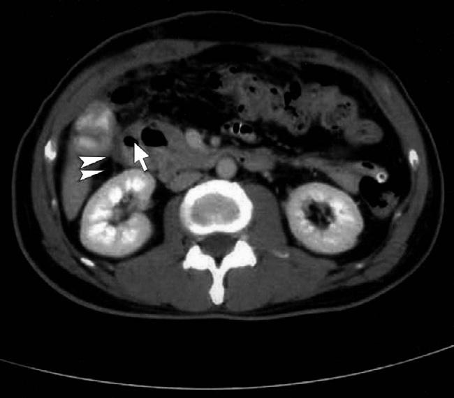 Perforated duodenal diverticulitis Figure 3.