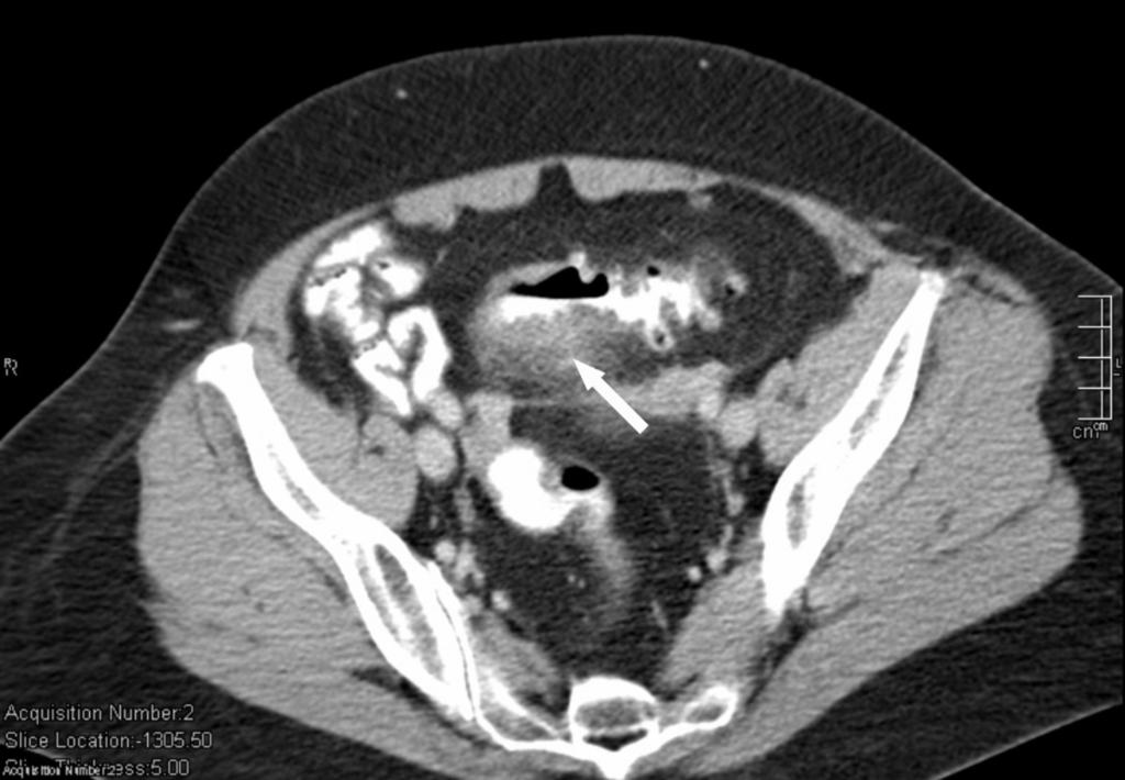 Conclusion CT is an accurate tool for staging in sigmoid diverticulitis using the Hansen and Stock classification.