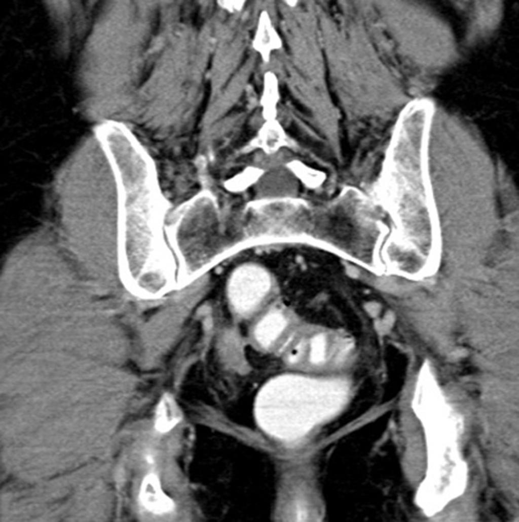 Fig. 1: Chronic recurrent diverticulitis (H&S type III) - axial CT image