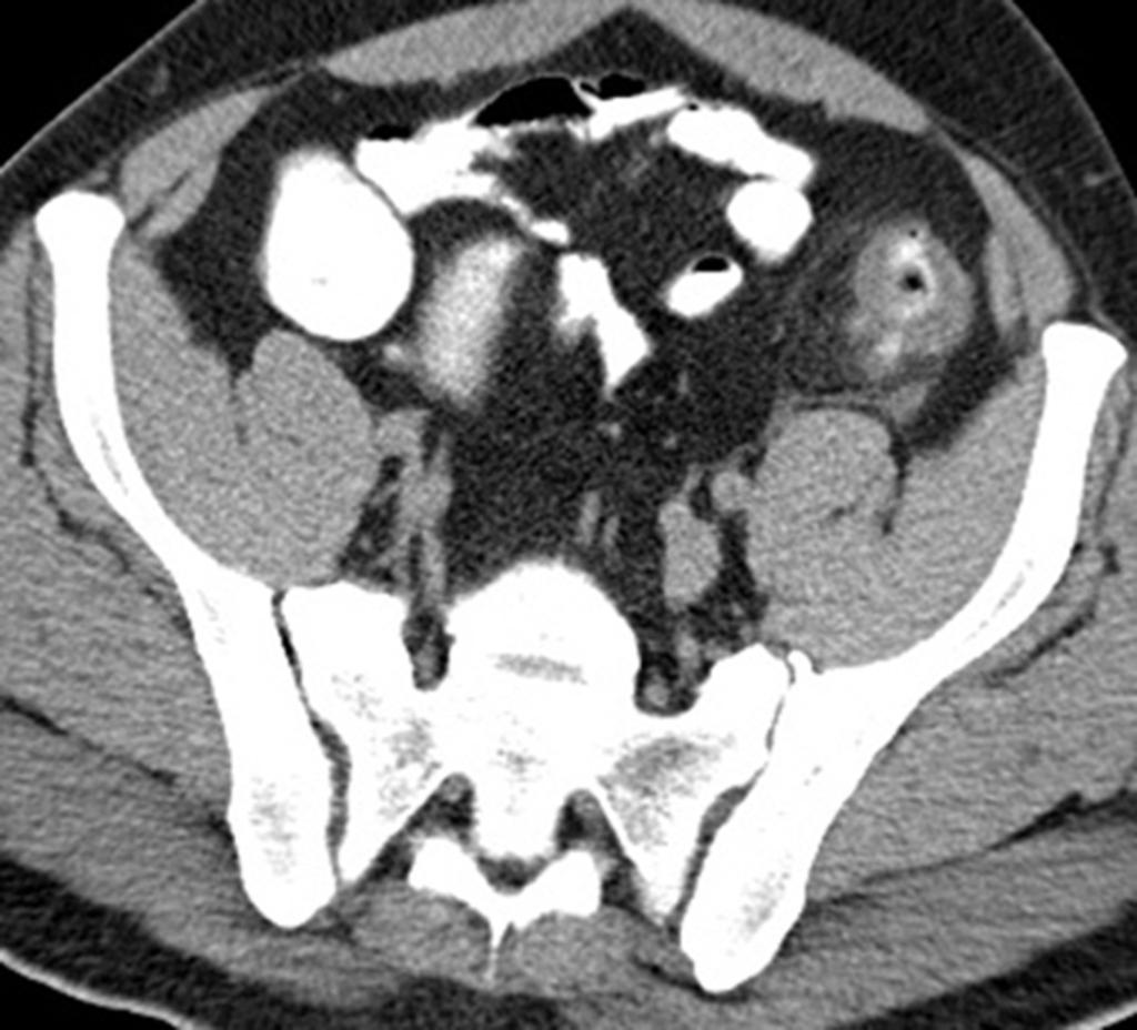 Fig. 2: Acute complicated diverticulitis (H&S type IIA) - axial CT image