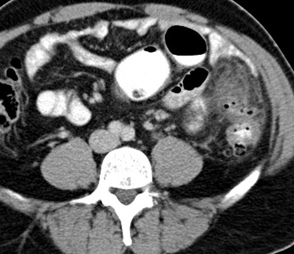 Fig. 3: Acute complicated diverticulitis (H&S type IIB) - axial CT image showing intramural abscess, colonic wall thickening and pericolic