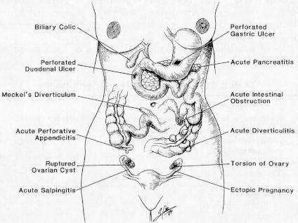 Acute Abdomen Symptoms and signs of acute intra- abdominal disease processes, usually