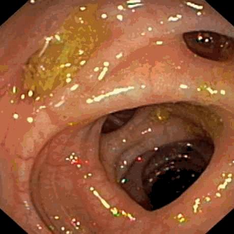 Investigation of diverticulosis Differential diagnosis IBS/
