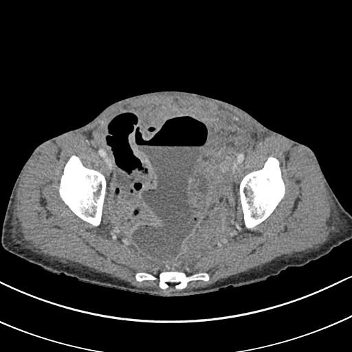 Diverticular abscess Fever Tachycardia Tenderness Mass High WCC/CRP Most are amenable to CT or US