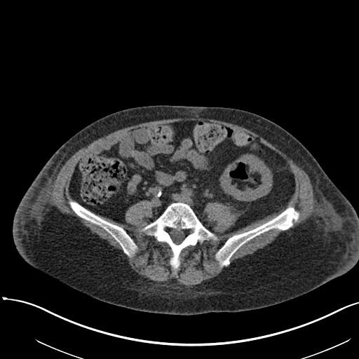 Colo-vesical fistula: diagnosis CT scan air in bladder fistula visible