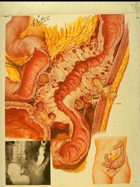 Entero-cutaneous fistula Not common Diverticular abscess discharges usually LIF pus