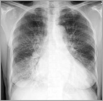 Case 3 54 y.o. woman with ischemic cardiomyopathy and baseline EF 30% presents with increased dyspnea and lower extremity edema over the past 4 days.
