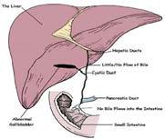 obstructive Progressive destruction of intra and extra hepatic bile ducts Can be classified according to the extent