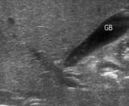 of age Ultrasound Etiology is unknown May be