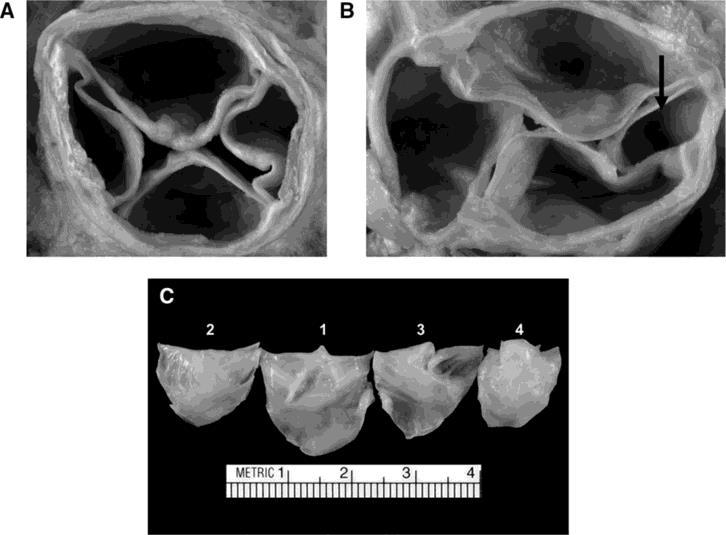 Pathological specimens of various subtypes of quadricuspid aortic valve. Michael Y.C. Tsang et al. Circulation.