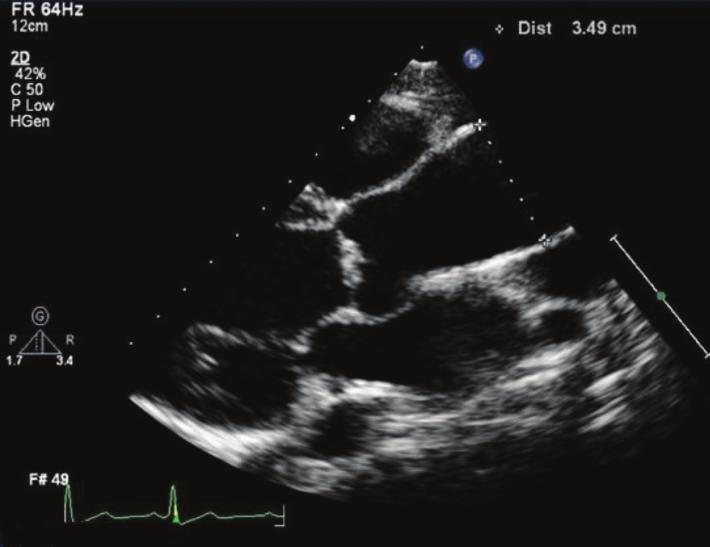 Mid ascending aorta at level of right pulmonary artery (inner edge-inner edge)