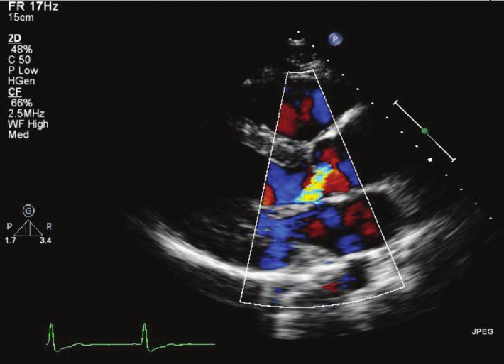 level of the aortic valve in the LVOT immediately below the flow convergence region