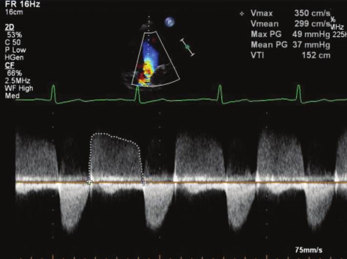 A5CH PW LVOT VTI (measured in LVOT up to 1 cm from aortic annulus) LVOT stroke volume =
