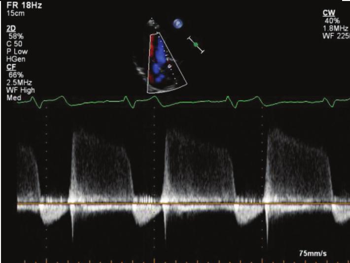 complete diastolic VTI envelope is seen to trace A5CH CW Pressure half-time Measure: