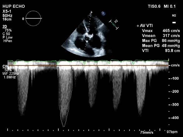 TAVR work up initiated Echo: Peak/mean aortic grads 86/48 mmhg, AVA