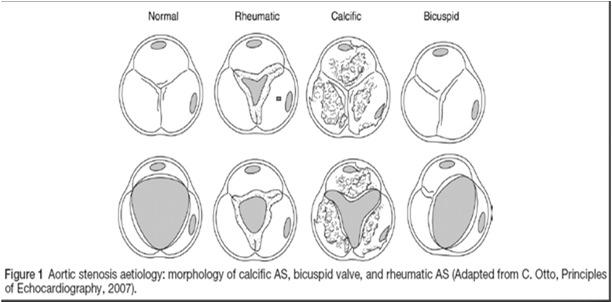 AHA/ACCF Staging of Aortic Stenosis (Stage A-D) Symptoms Valve anatomy Bicuspid Calcification