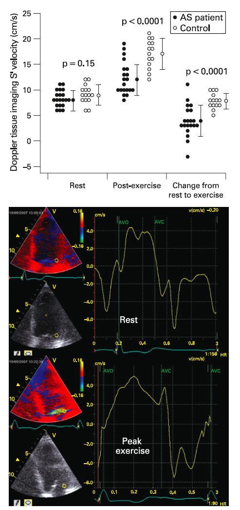 Newer Stress Parameters in AS Tissue Doppler and Stress Echocardiography Van Pelt et al Heart 2007 Lack of substantial increase in S