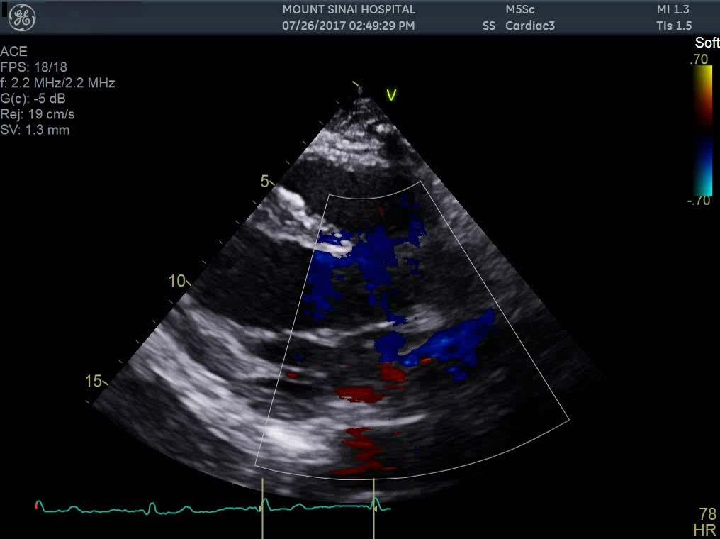 4-month F/U Transthoracic Echocardiogram