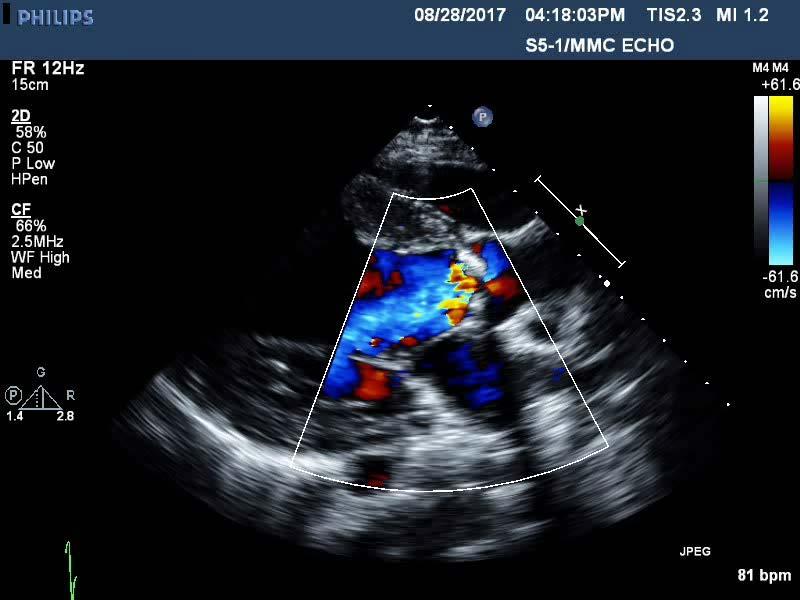 Case 2 26 year old male with remote history of heart murmur Progressive