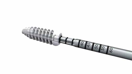 The BIOSURE REGENESORB Interference Screw exhibits the fixation strength of a solid absorbable interference screw without statistical difference throughout the healing period in a simulated