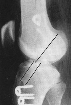 Introduction Contact between an ACL graft and the intercondylar roof can cause graft failure and poor outcomes Howell et al.