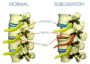Subluxation = Interference = Dis-ease The sole purpose of chiropractic is to locate and correct subluxations. Detecting subluxations is a complicated and exacting science.