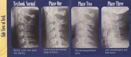 Chiropractors have known the dangers of the vertebral subluxation complex ever since the birth of the profession.